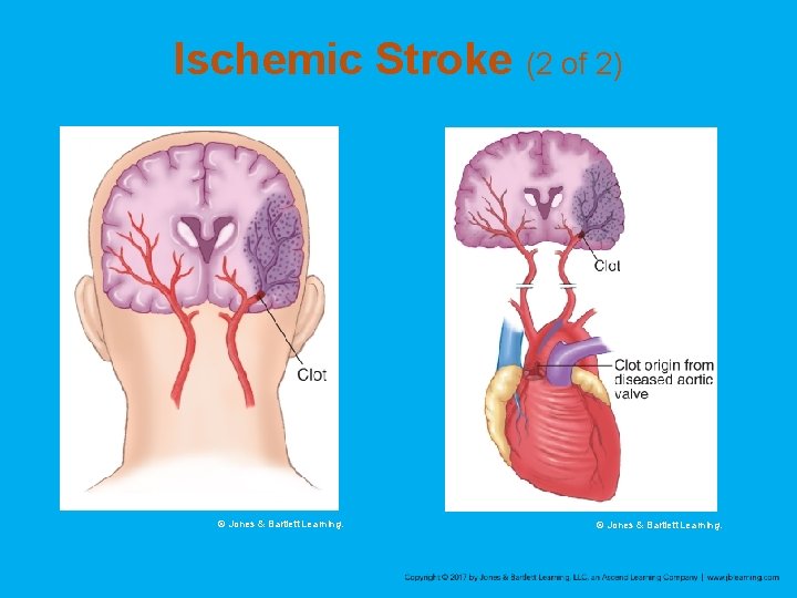 Ischemic Stroke (2 of 2) © Jones & Bartlett Learning. 