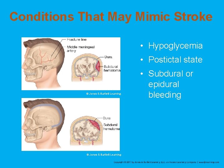 Conditions That May Mimic Stroke • Hypoglycemia • Postictal state © Jones & Bartlett