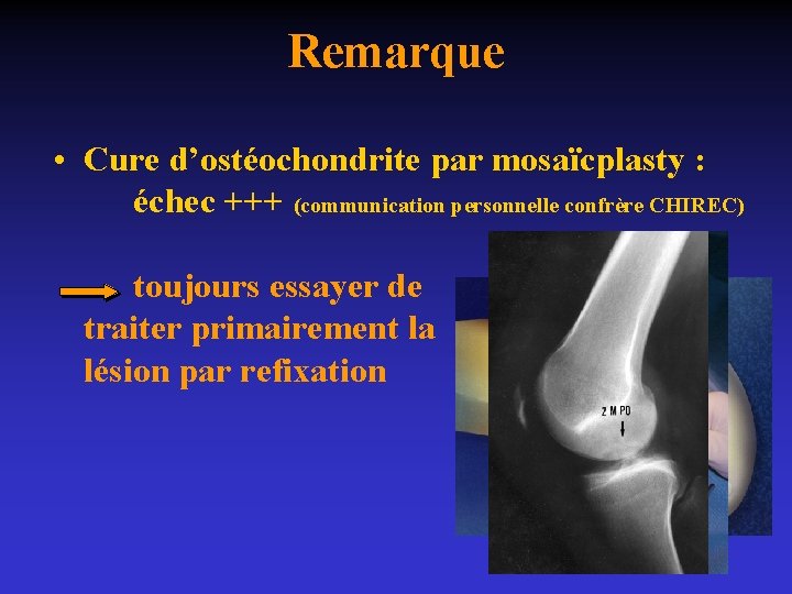 Remarque • Cure d’ostéochondrite par mosaïcplasty : échec +++ (communication personnelle confrère CHIREC) toujours