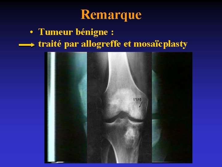 Remarque • Tumeur bénigne : traité par allogreffe et mosaïcplasty 