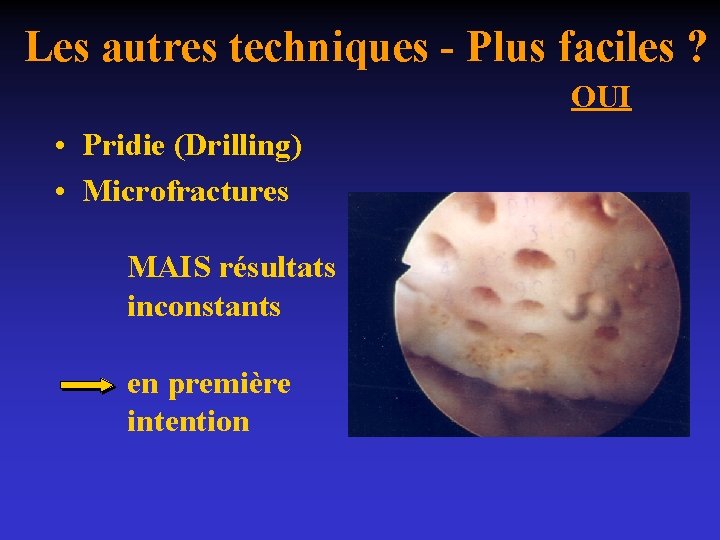 Les autres techniques - Plus faciles ? OUI • Pridie (Drilling) • Microfractures MAIS