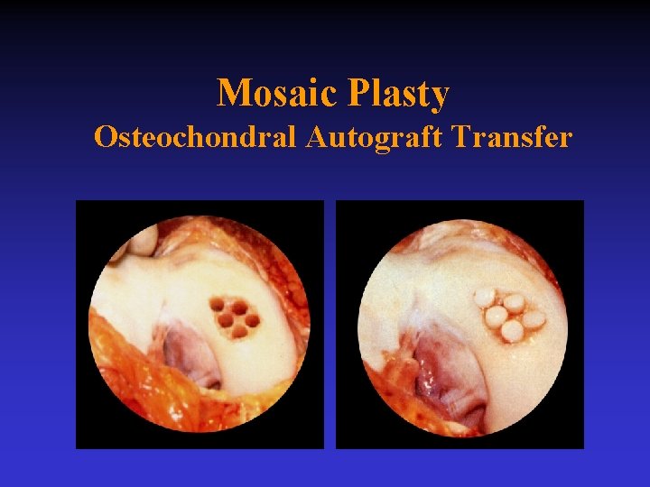 Mosaic Plasty Osteochondral Autograft Transfer 