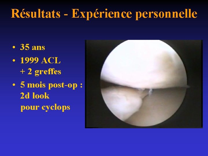 Résultats - Expérience personnelle • 35 ans • 1999 ACL + 2 greffes •