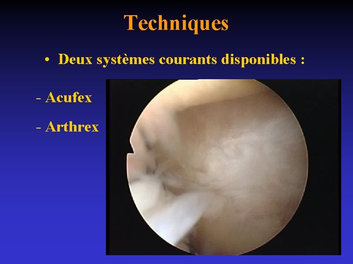 Techniques • Deux systèmes courants disponibles : - Acufex - Arthrex 