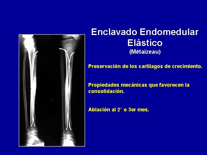 Enclavado Endomedular Elástico (Métaizeau) Preservación de los cartílagos de crecimiento. Propiedades mecánicas que favorecen