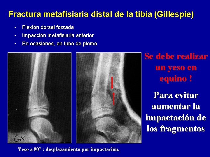Fractura metafisiaria distal de la tibia (Gillespie) • Flexión dorsal forzada • Impacción metafisiaria