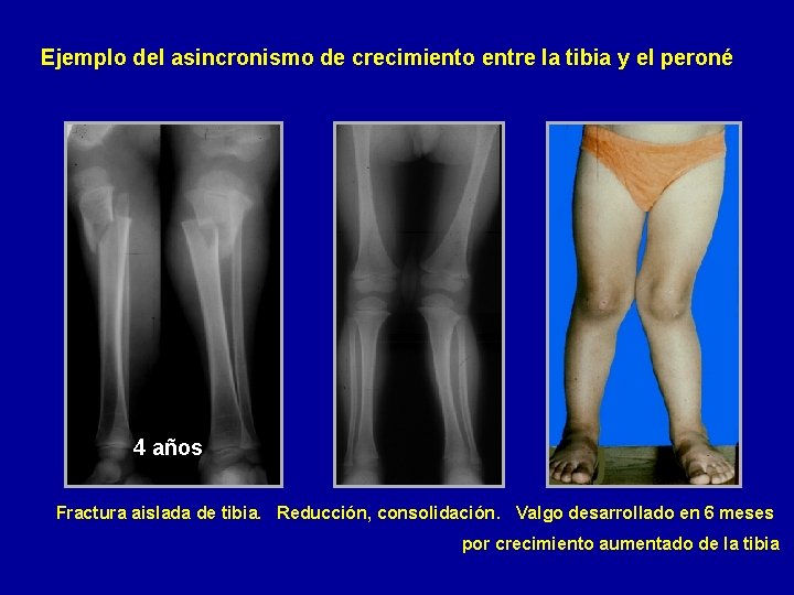 Ejemplo del asincronismo de crecimiento entre la tibia y el peroné 4 años Fractura