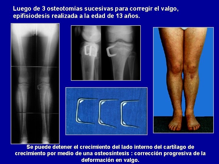 Luego de 3 osteotomías sucesivas para corregir el valgo, epifisiodesis realizada a la edad