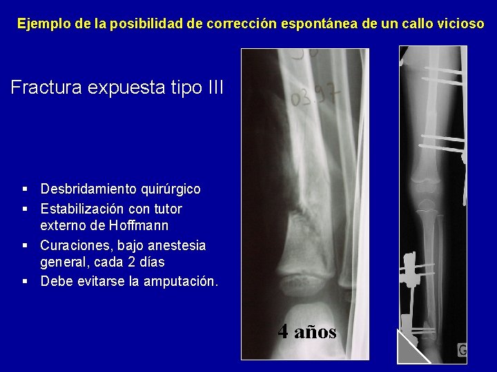 Ejemplo de la posibilidad de corrección espontánea de un callo vicioso Fractura expuesta tipo