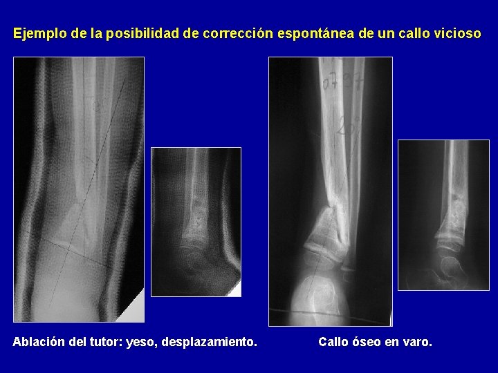 Ejemplo de la posibilidad de corrección espontánea de un callo vicioso Ablación del tutor: