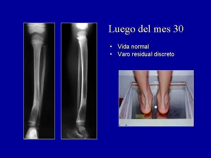Luego del mes 30 • Vida normal • Varo residual discreto 