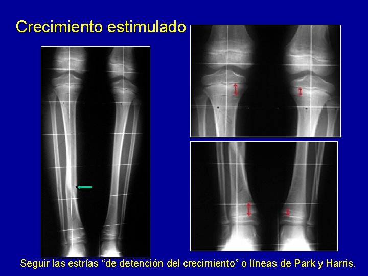 Crecimiento estimulado Seguir las estrías “de detención del crecimiento” o líneas de Park y