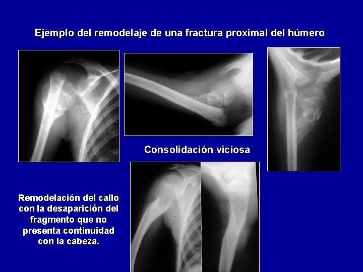 Ejemplo del remodelaje de una fractura proximal del húmero Consolidación viciosa Remodelación del callo