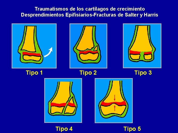 Traumatismos de los cartílagos de crecimiento Desprendimientos Epifisiarios-Fracturas de Salter y Harris Tipo 1