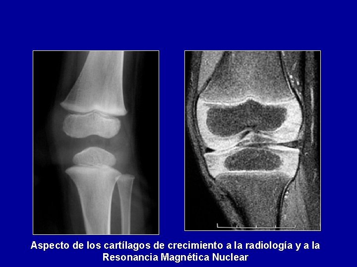 Aspecto de los cartílagos de crecimiento a la radiología y a la Resonancia Magnética