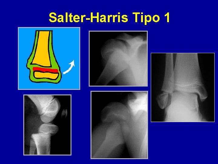 Salter-Harris Tipo 1 