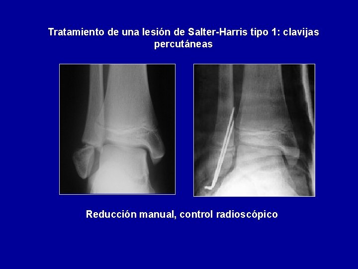 Tratamiento de una lesión de Salter-Harris tipo 1: clavijas percutáneas Reducción manual, control radioscópico