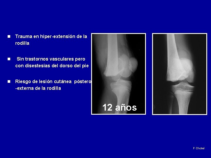 n Trauma en hiper-extensión de la rodilla n Sin trastornos vasculares pero con disestesias