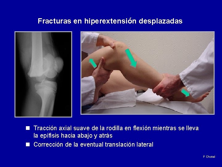 Fracturas en hiperextensión desplazadas n Tracción axial suave de la rodilla en flexión mientras