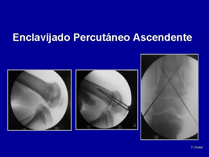 Enclavijado Percutáneo Ascendente F Chotel 