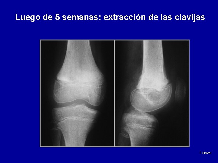 Luego de 5 semanas: extracción de las clavijas F Chotel 