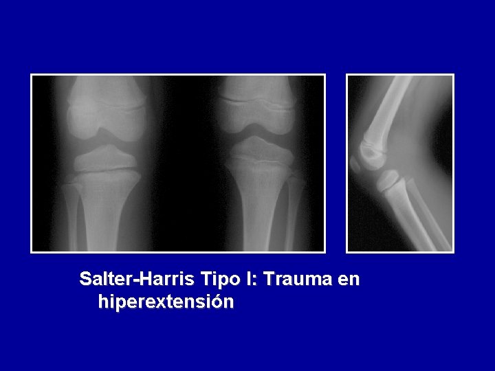 Salter-Harris Tipo I: Trauma en hiperextensión 