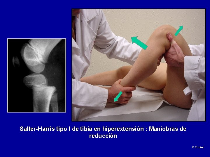 Salter-Harris tipo I de tibia en hiperextensión : Maniobras de reducción F Chotel 