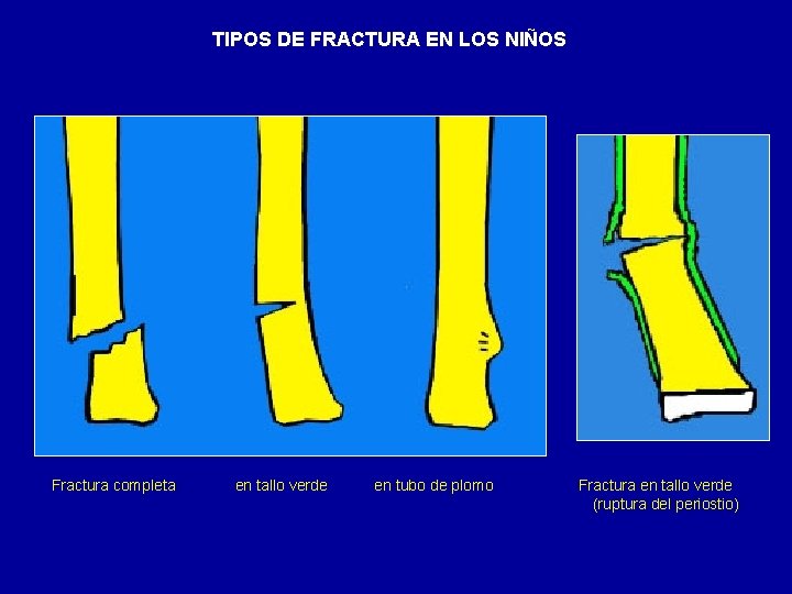 TIPOS DE FRACTURA EN LOS NIÑOS Fractura completa en tallo verde en tubo de
