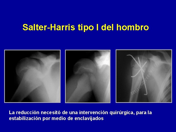 Salter-Harris tipo I del hombro La reducción necesitó de una intervención quirúrgica, para la