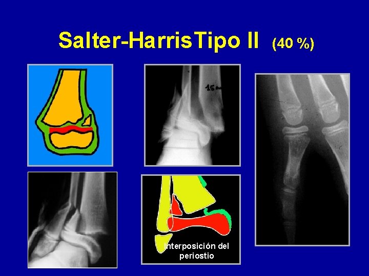 Salter-Harris. Tipo II Interposición del periostio (40 %) 