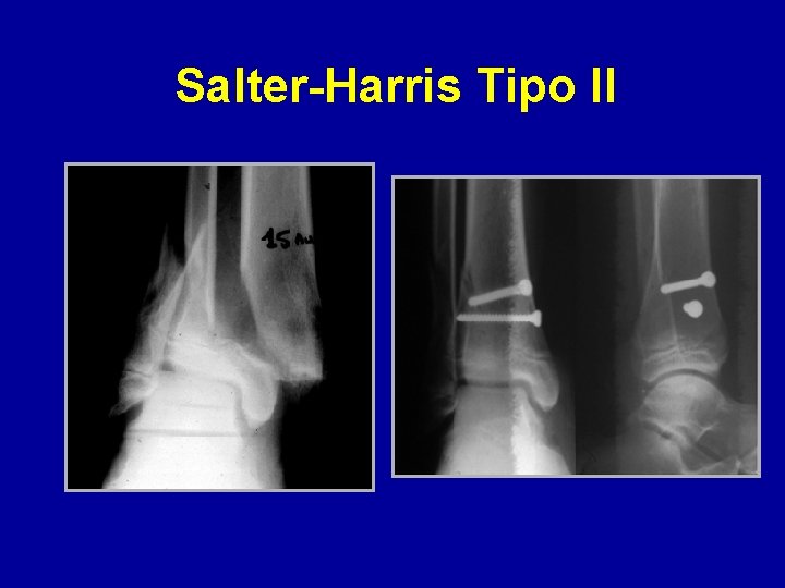 Salter-Harris Tipo II 