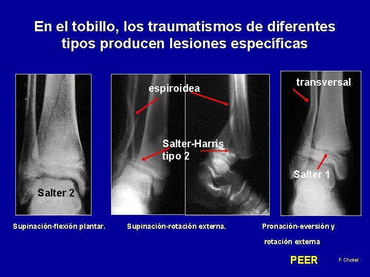 En el tobillo, los traumatismos de diferentes tipos producen lesiones específicas espiroidea transversal Salter-Harris