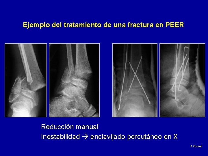 Ejemplo del tratamiento de una fractura en PEER Reducción manual Inestabilidad enclavijado percutáneo en