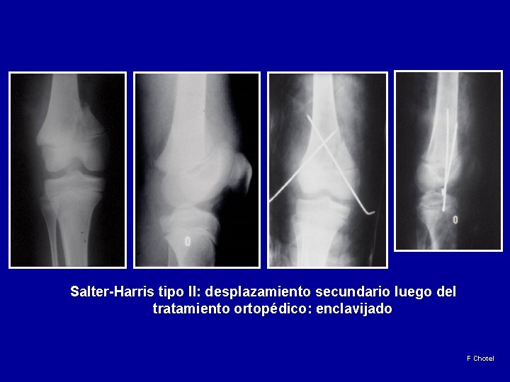 Salter-Harris tipo II: desplazamiento secundario luego del tratamiento ortopédico: enclavijado F Chotel 