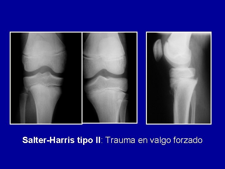 Salter-Harris tipo II: Trauma en valgo forzado 