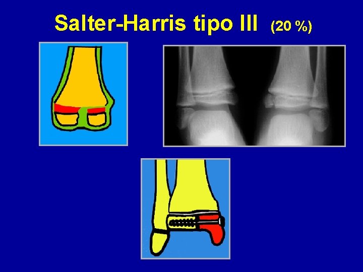 Salter-Harris tipo III (20 %) 