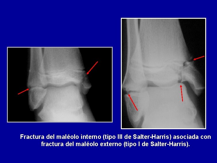 Fractura del maléolo interno (tipo III de Salter-Harris) asociada con fractura del maléolo externo