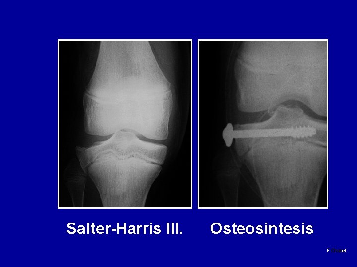 Salter-Harris III. Osteosintesis F Chotel 
