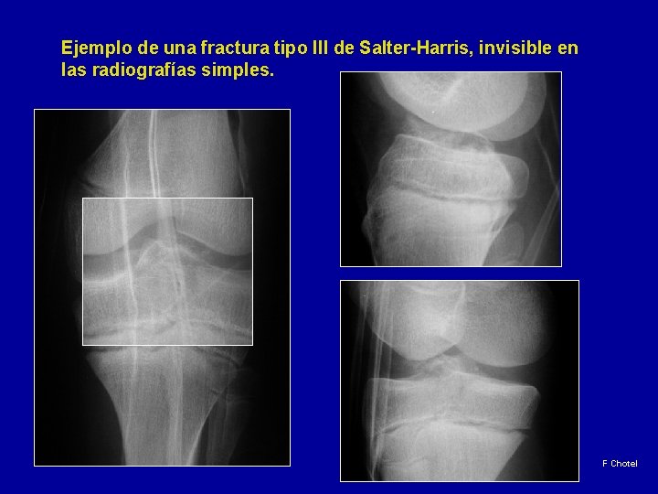Ejemplo de una fractura tipo III de Salter-Harris, invisible en las radiografías simples. F