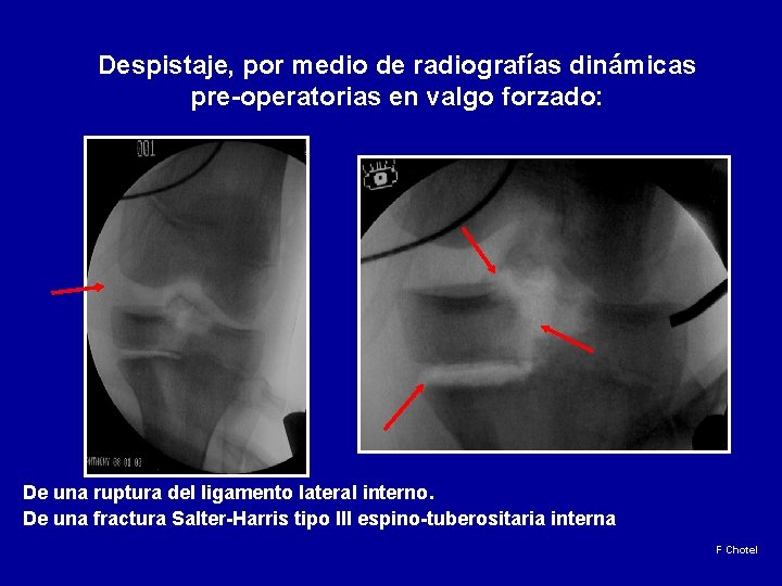 Despistaje, por medio de radiografías dinámicas pre-operatorias en valgo forzado: De una ruptura del