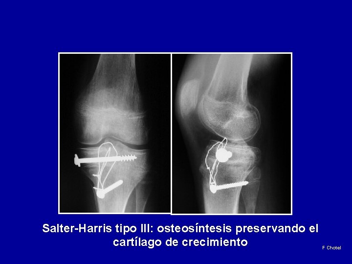 Salter-Harris tipo III: osteosíntesis preservando el cartílago de crecimiento F Chotel 
