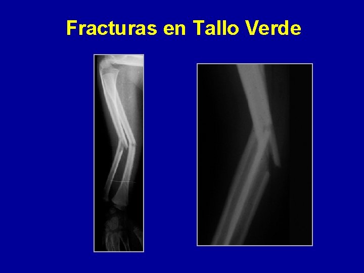 Fracturas en Tallo Verde 