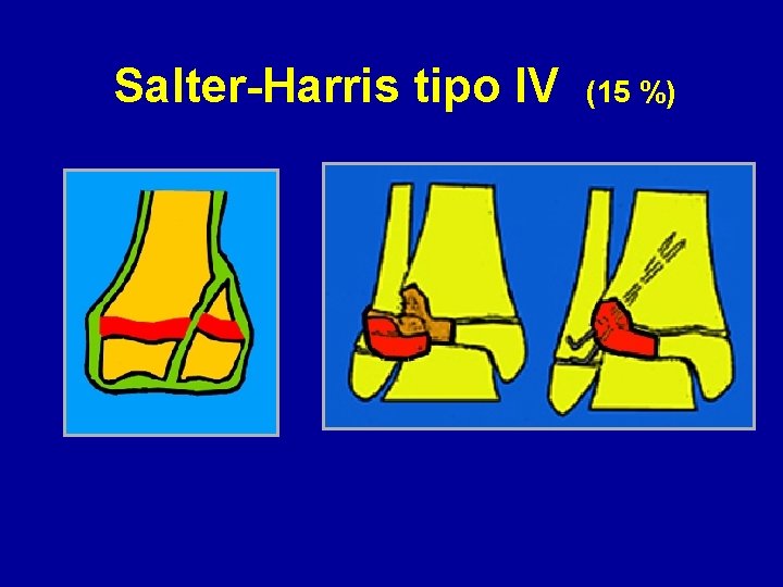 Salter-Harris tipo IV (15 %) 