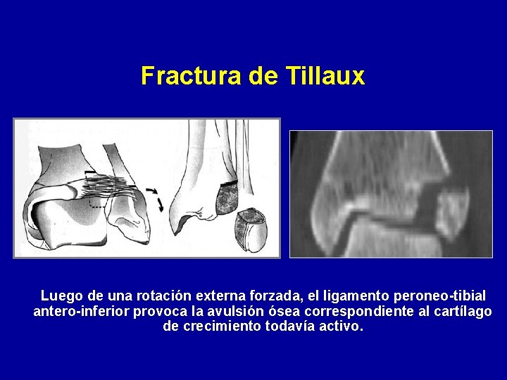 Fractura de Tillaux Luego de una rotación externa forzada, el ligamento peroneo-tibial antero-inferior provoca