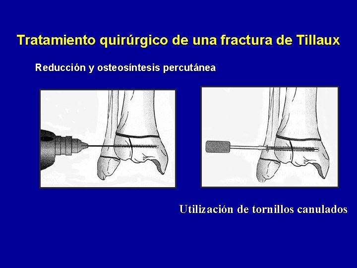 Tratamiento quirúrgico de una fractura de Tillaux Reducción y osteosíntesis percutánea Utilización de tornillos