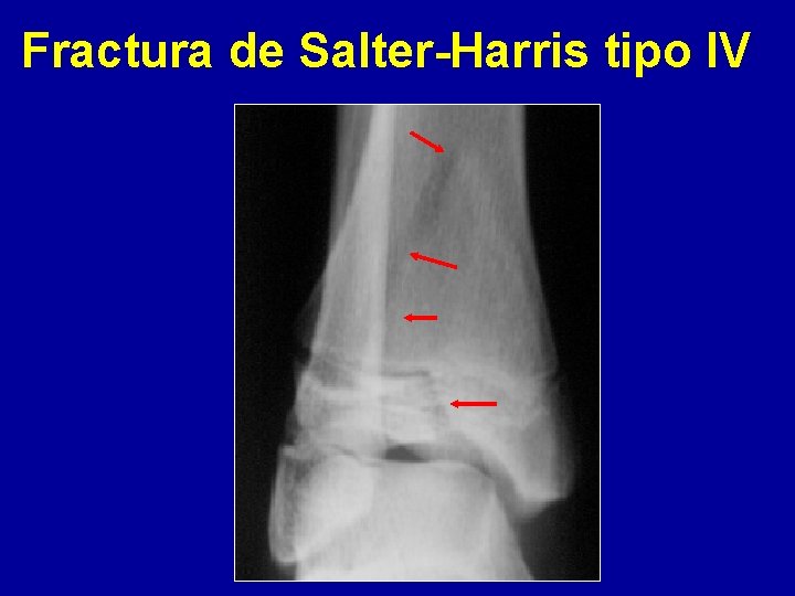 Fractura de Salter-Harris tipo IV 