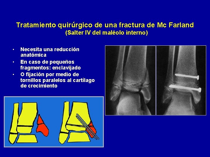 Tratamiento quirúrgico de una fractura de Mc Farland (Salter IV del maléolo interno) •
