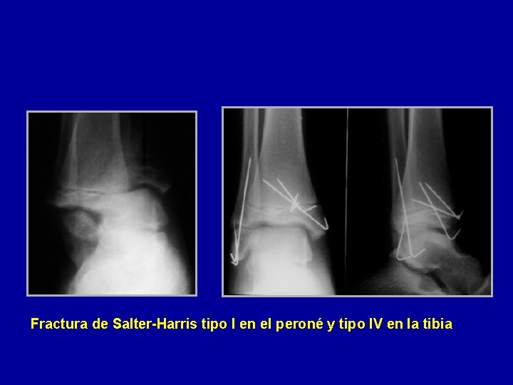 Fractura de Salter-Harris tipo I en el peroné y tipo IV en la tibia