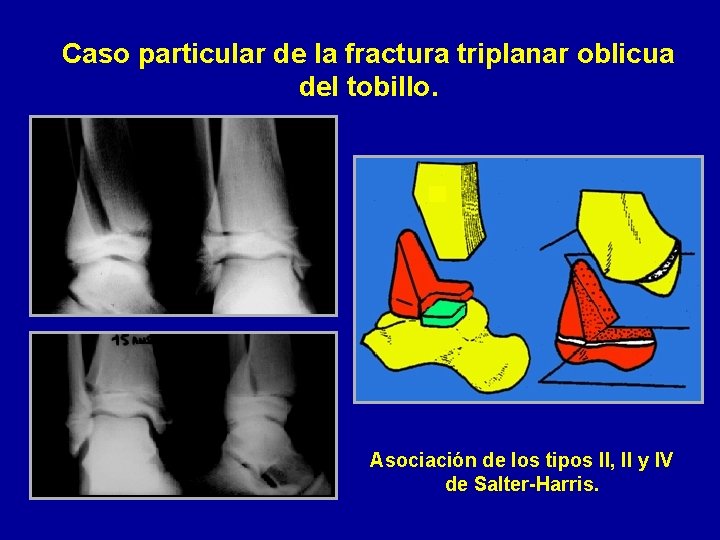 Caso particular de la fractura triplanar oblicua del tobillo. Asociación de los tipos II,