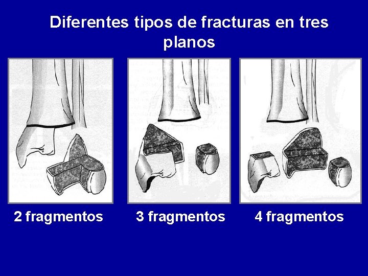 Diferentes tipos de fracturas en tres planos 2 fragmentos 3 fragmentos 4 fragmentos 